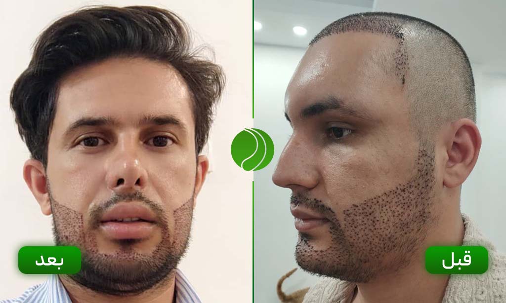 کاشت ریش