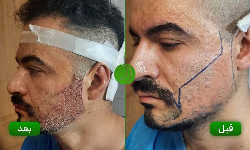 کاشت ریش