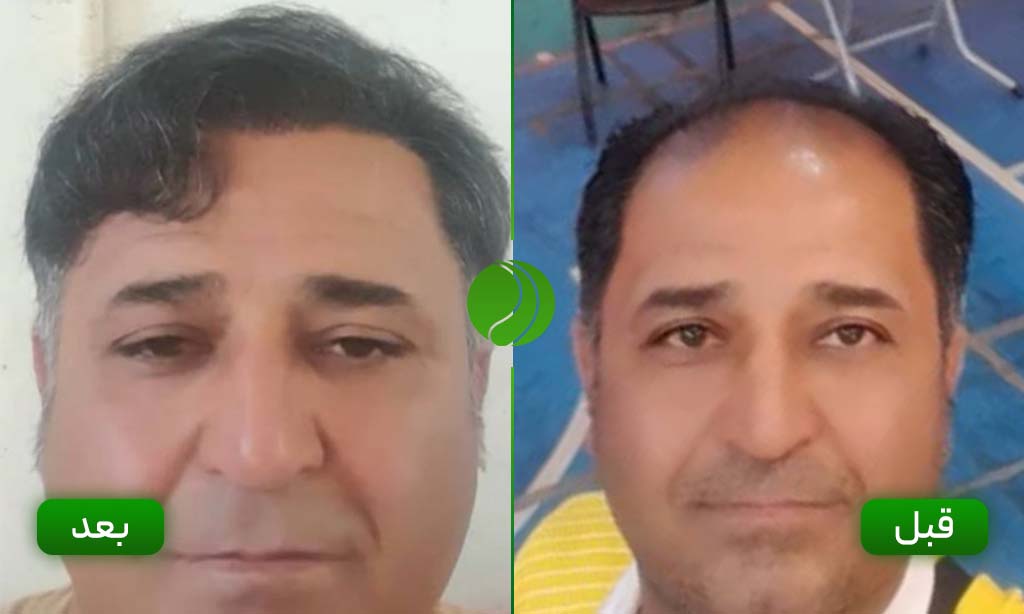 کاشت مو