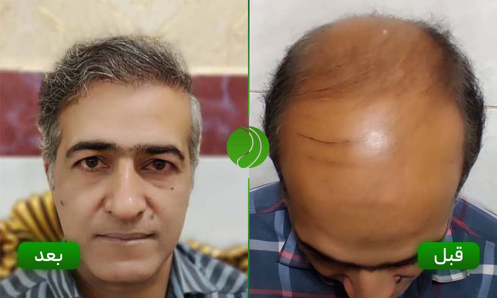 کاشت مو