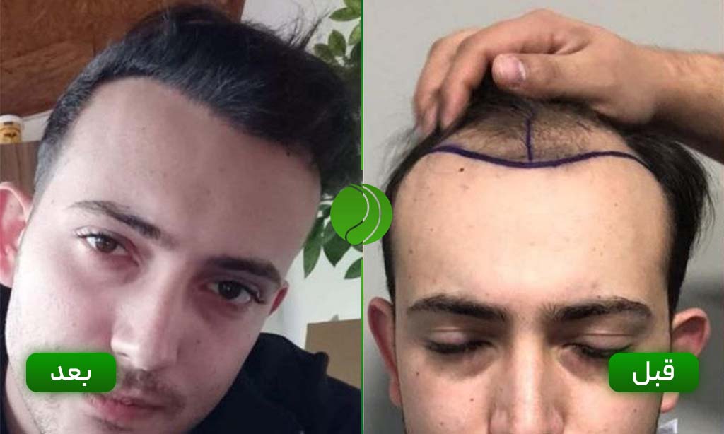 کاشت مو